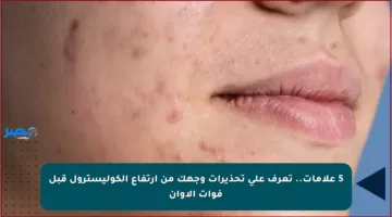 5 علامات.. تعرف على تحذيرات وجهك من ارتفاع الكوليسترول قبل فوات الأوان